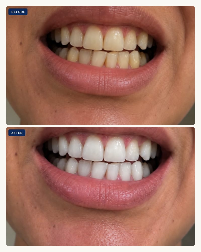 Before and after, gumline stain