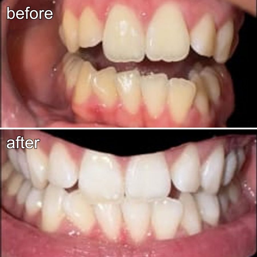Customer submitted before and after smile photos