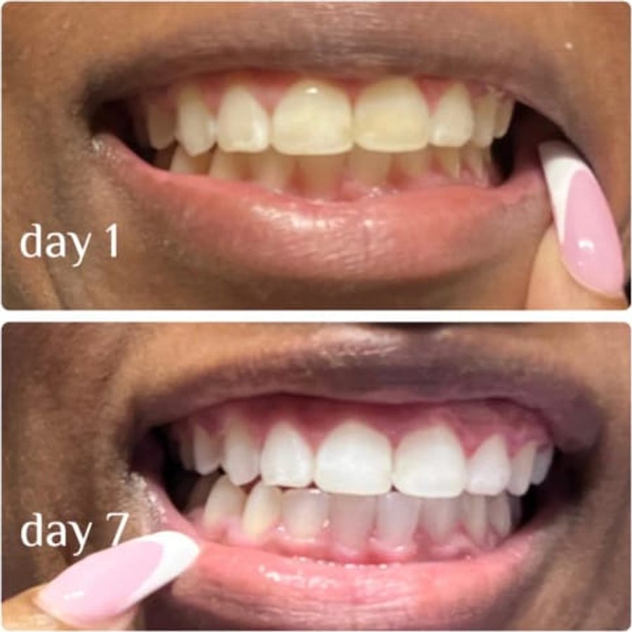 Customer submitted smile photos from day 1 and day 7